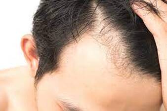 Hair Loss Treatment - Essential Men's Clinic