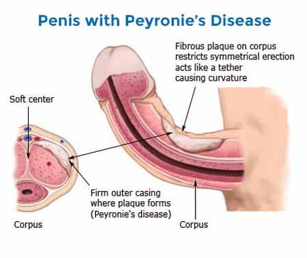 Diagram showing Peyronie’s disease with fibrous plaque causing penile curvature during erection
