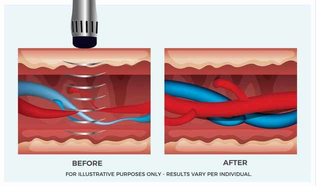 visual-representation-of-the-effects-of-extracorporeal-shockwave-therapy
